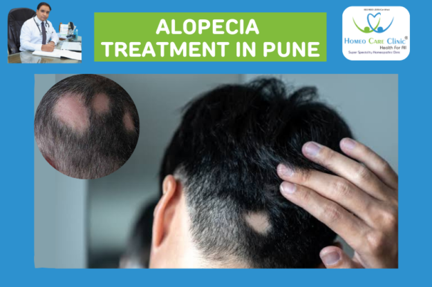 Expert alopecia areata treatment in Pune by specialists