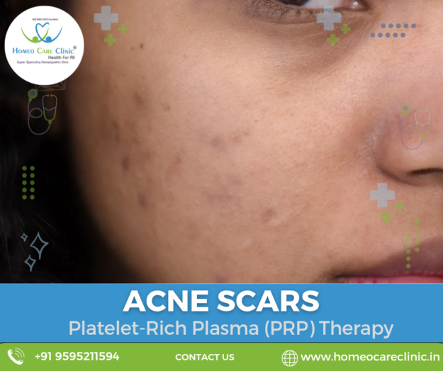 PRP for acne scar healing