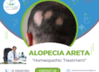 Sudden hair loss due to Alopecia Areata with visible bald patches