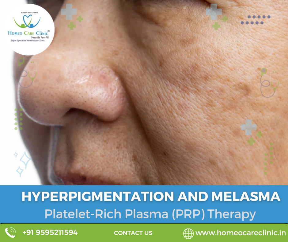PRP therapy for melasma treatment