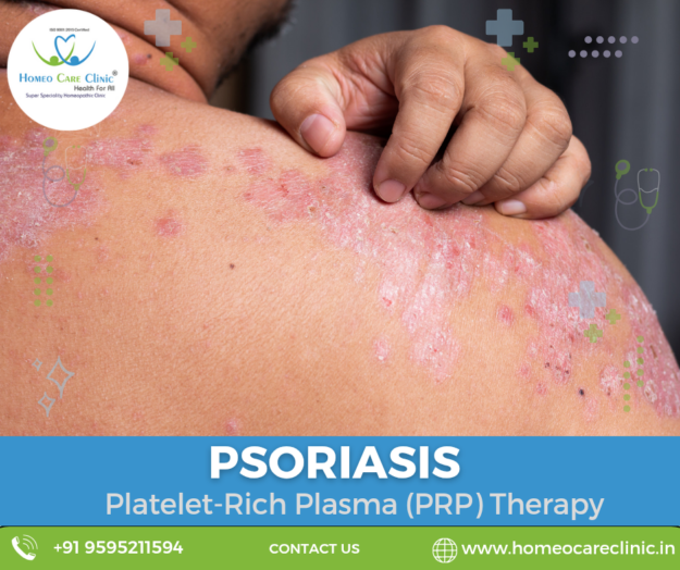 Platelet-Rich Plasma (PRP) therapy for psoriasis skin treatment.