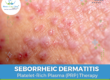 PRP therapy reducing seborrheic dermatitis