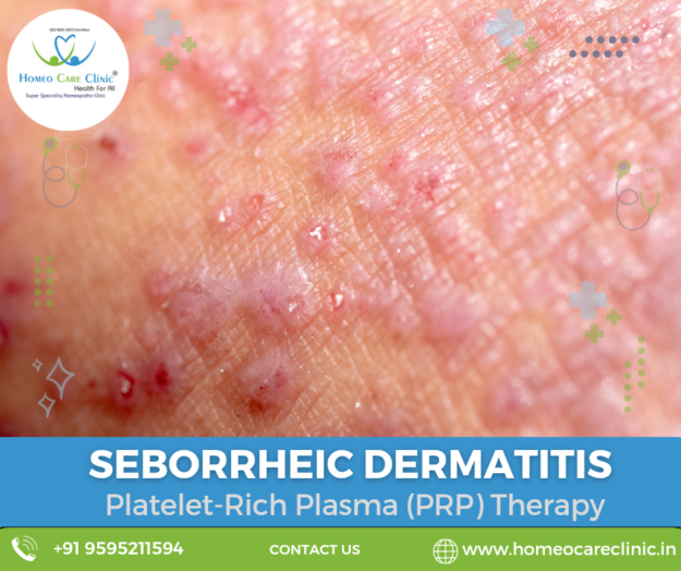 PRP therapy reducing seborrheic dermatitis