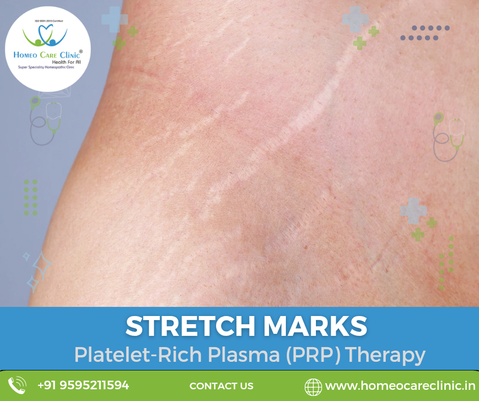PRP therapy for stretch marks and its benefits Stretch marks treatment
