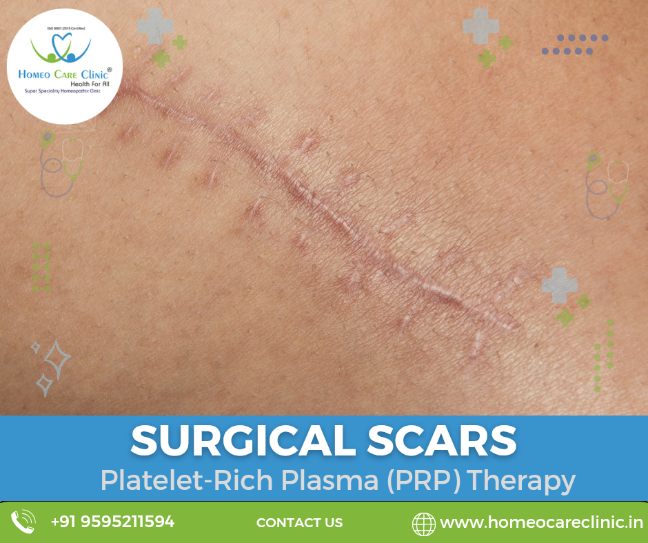 urgical Scars Treatment Options Using PRP PRP therapy benefits for surgical scars.