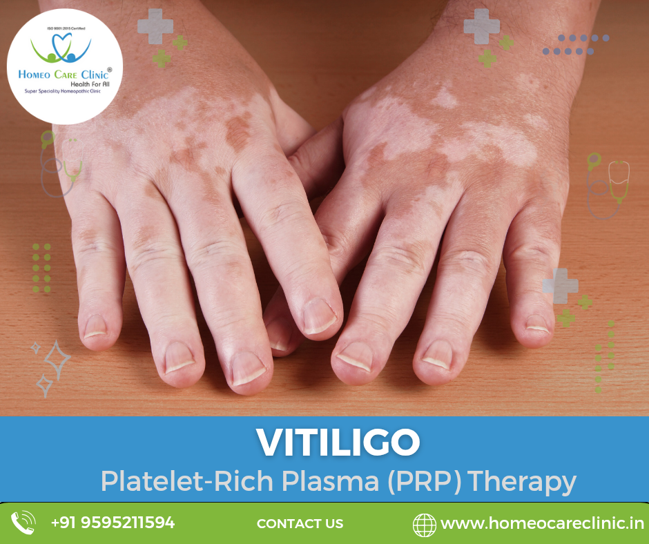 treatments for vitiligo using PRP therapy Platelet-rich plasma therapy