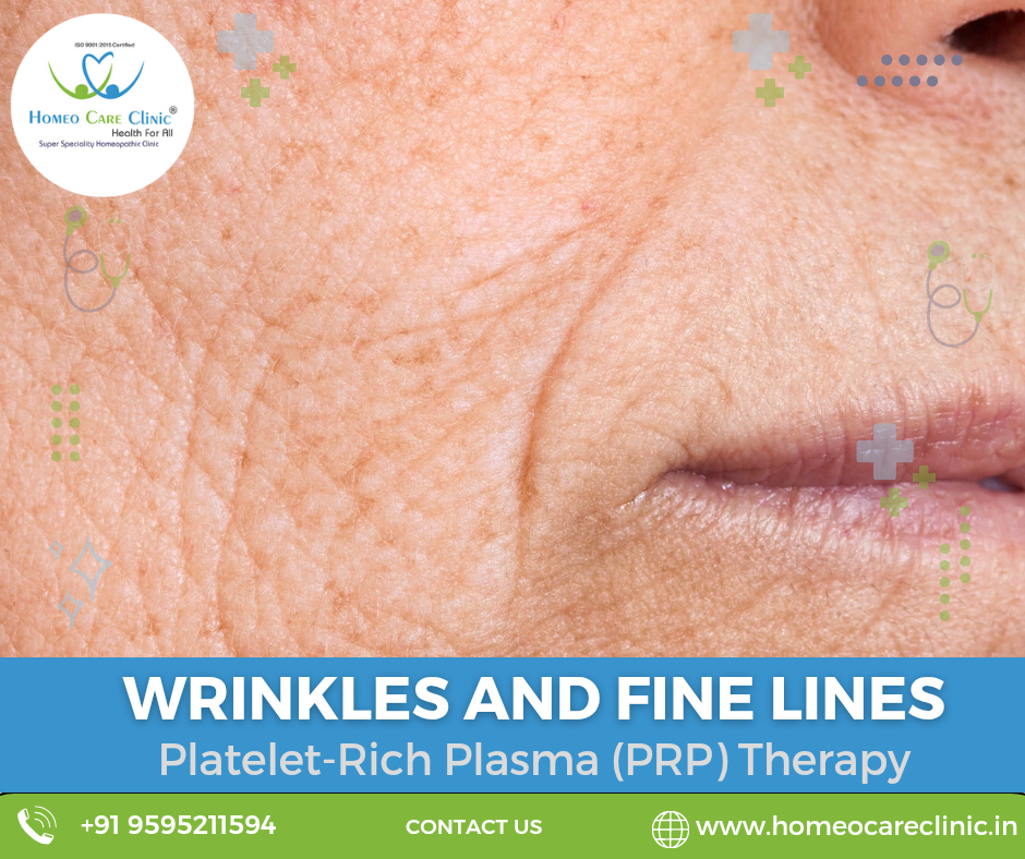 Fine Lines and Wrinkles Treatment PRP therapy for fine lines and wrinkles treatment.