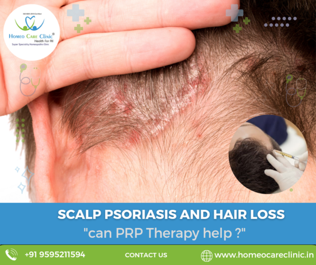 PRP therapy and homeopathic solutions for scalp psoriasis hair loss Advanced PRP therapy for scalp psoriasis and hair loss