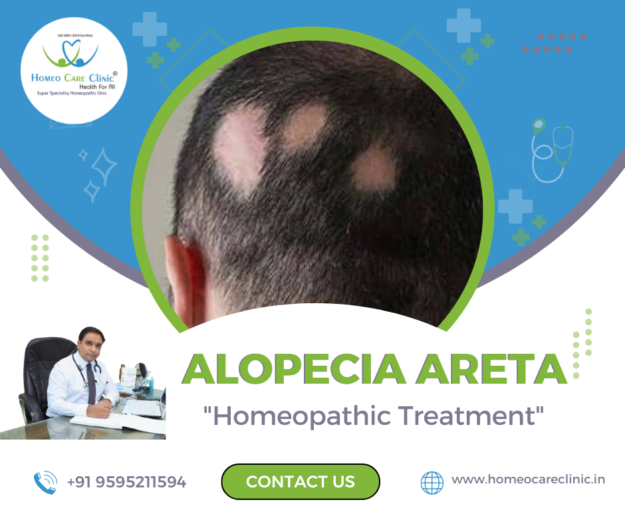 Sudden Hair Loss: Alopecia Areata Explained Sudden hair loss due to Alopecia Areata with visible bald patches