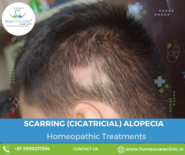 Causes and treatments for scarring alopecia