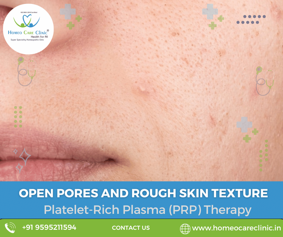 PRP treatment for enlarged pores