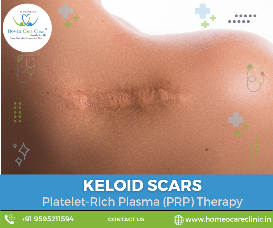 PRP therapy for keloid scars
