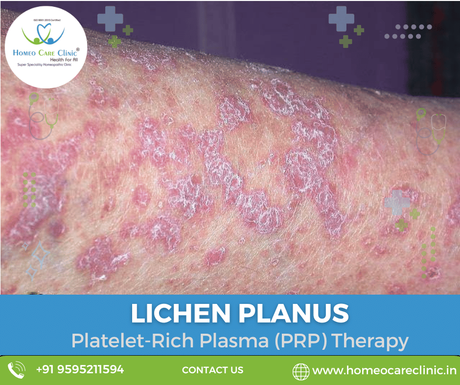 lichen planus  treatment lichen planus lesions on the skin