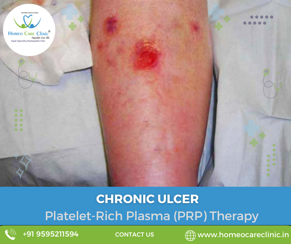 Chronic skin ulcer treatment with PRP therapy