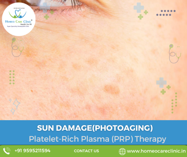 PRP therapy for sun damage Sun damage skin treatment with PRP therapy