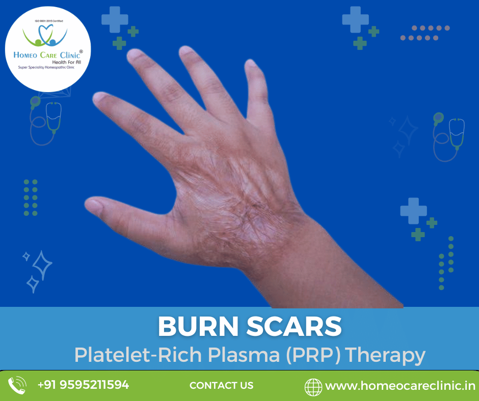 burn scars with PRP therapy Burn scars treatment using PRP therapy