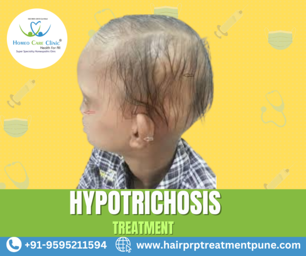 hypotrichosis PRP and Homeopathy Treatment combination Hypotrichosis PRP treatment