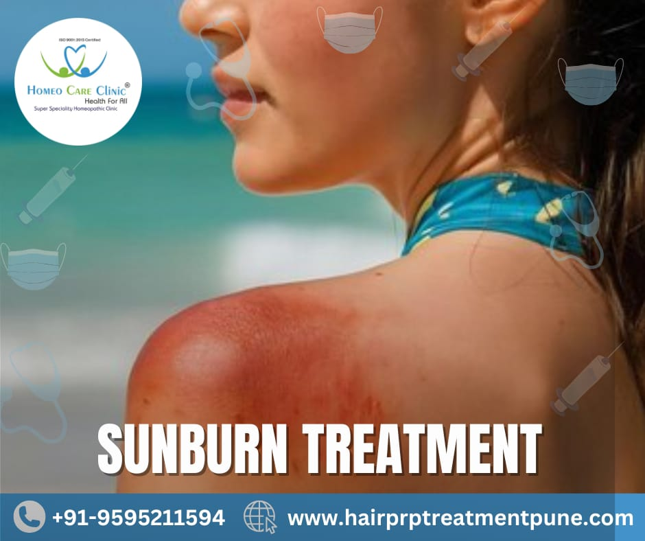 PRP therapy helps in sunburn recovery Medical PRP treatment for sunburn