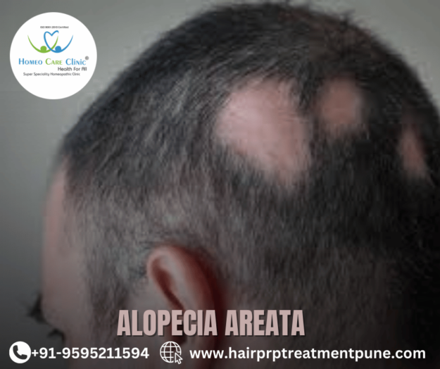 Alopecia & alopecia areata PRP hair regrowth Alopecia & alopecia areata symptoms