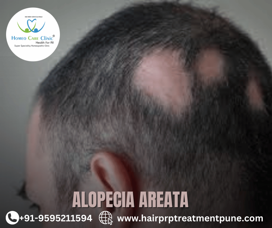 Alopecia & alopecia areata PRP hair regrowth Alopecia & alopecia areata symptoms