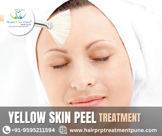 Yellow Peel session targeting facial pigmentation Yellow Peel for Pigmentation and Acne