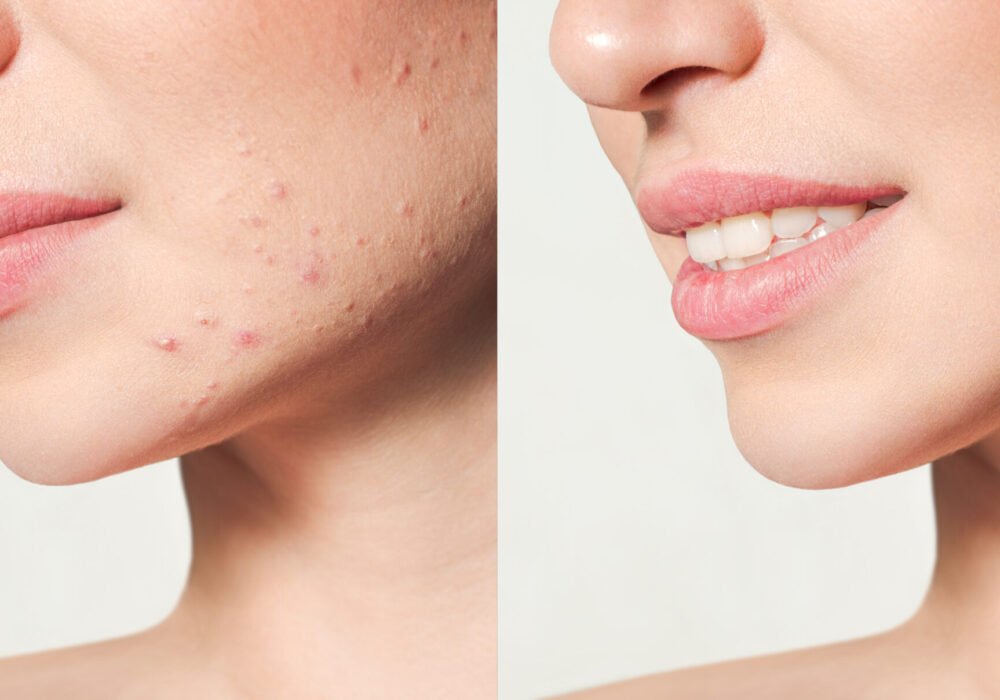 Acne Scars Treatment in Pune