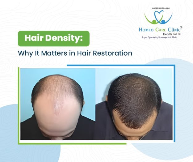 Hair Density Hair Restoration