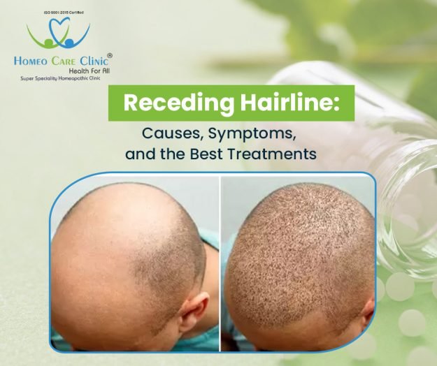 What is Receding Hariline & Treatment Receding Hairline Causes & Symptoms
