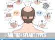 types of hair transplants
