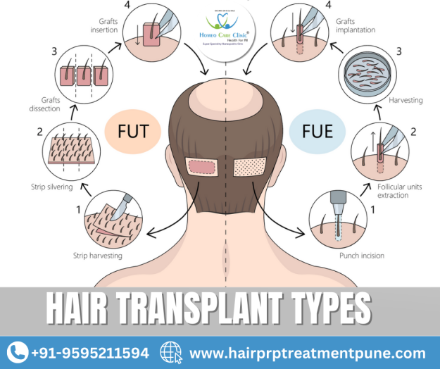 Different types of hair transplant surgery and treatments types of hair transplants