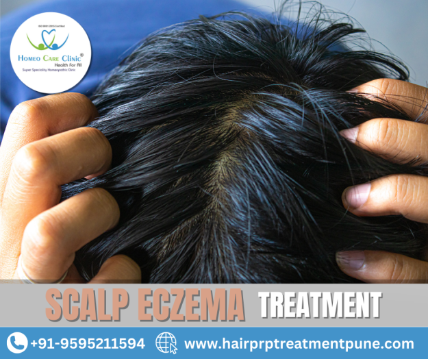 scalp eczema treatment