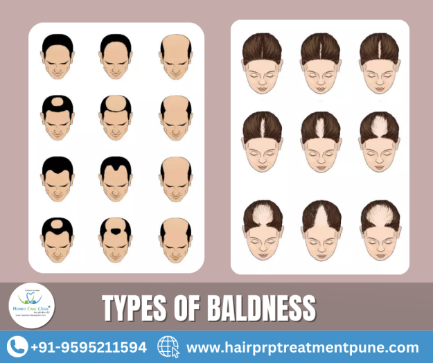 baldness treatment types of baldness