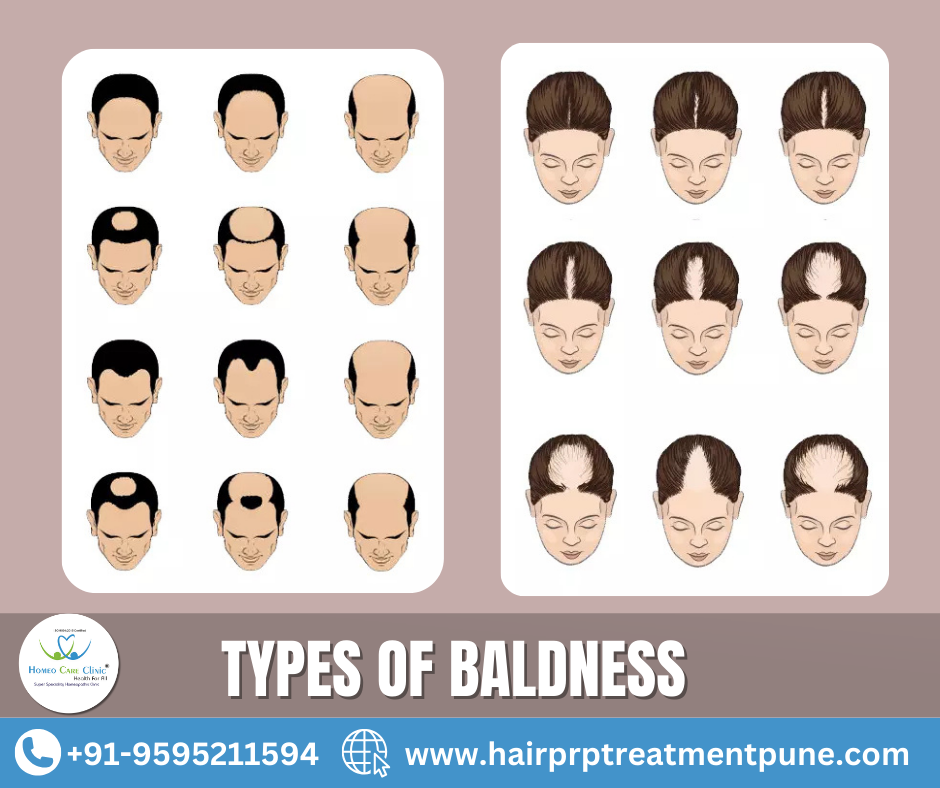 baldness treatment types of baldness