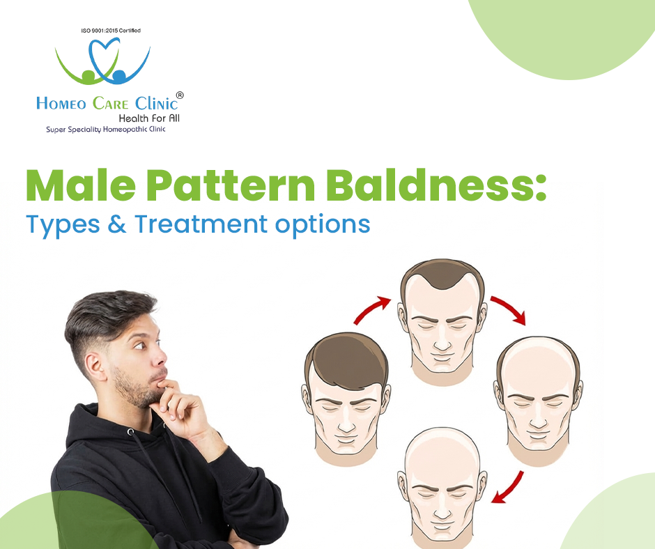 Types of Male Pattern Baldness