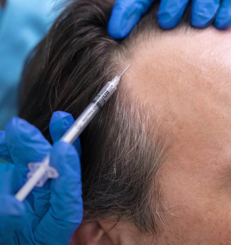 GFC Hair Treatment in Pune - Hairprptreatmentpune