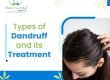 Types of Dandruff and Its Treatment