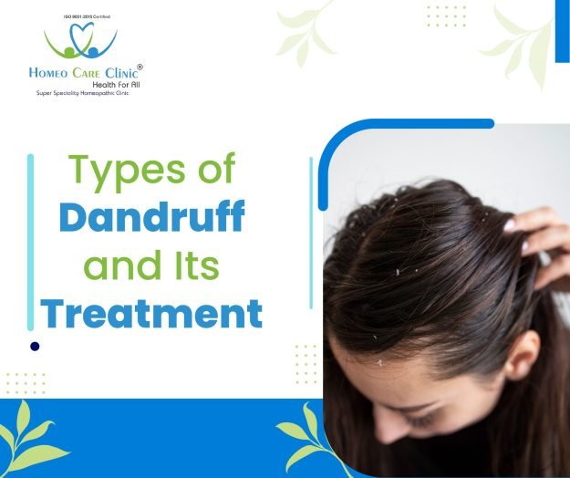Types of Dandruff and Its Treatment
